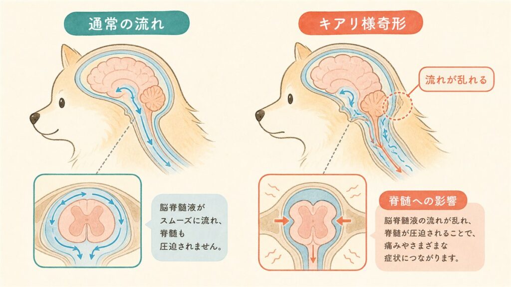 キアリ様奇形と脊髄空洞症の関係を説明する図